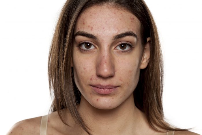 Middle aged woman with acne