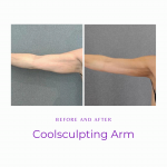 Before and After of arm with Coolsculpting