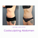 Before and after images of fat freezing abdomen