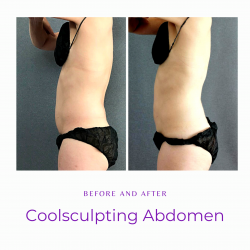 Before and After Coolsculpting abdomen