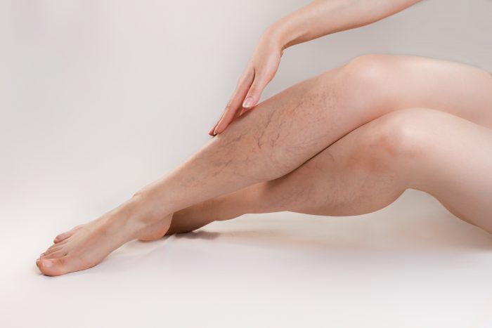 legs with varicose veins
